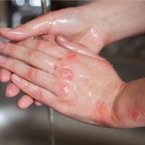 wn-tree-of-life-empire-eczema-testimonial