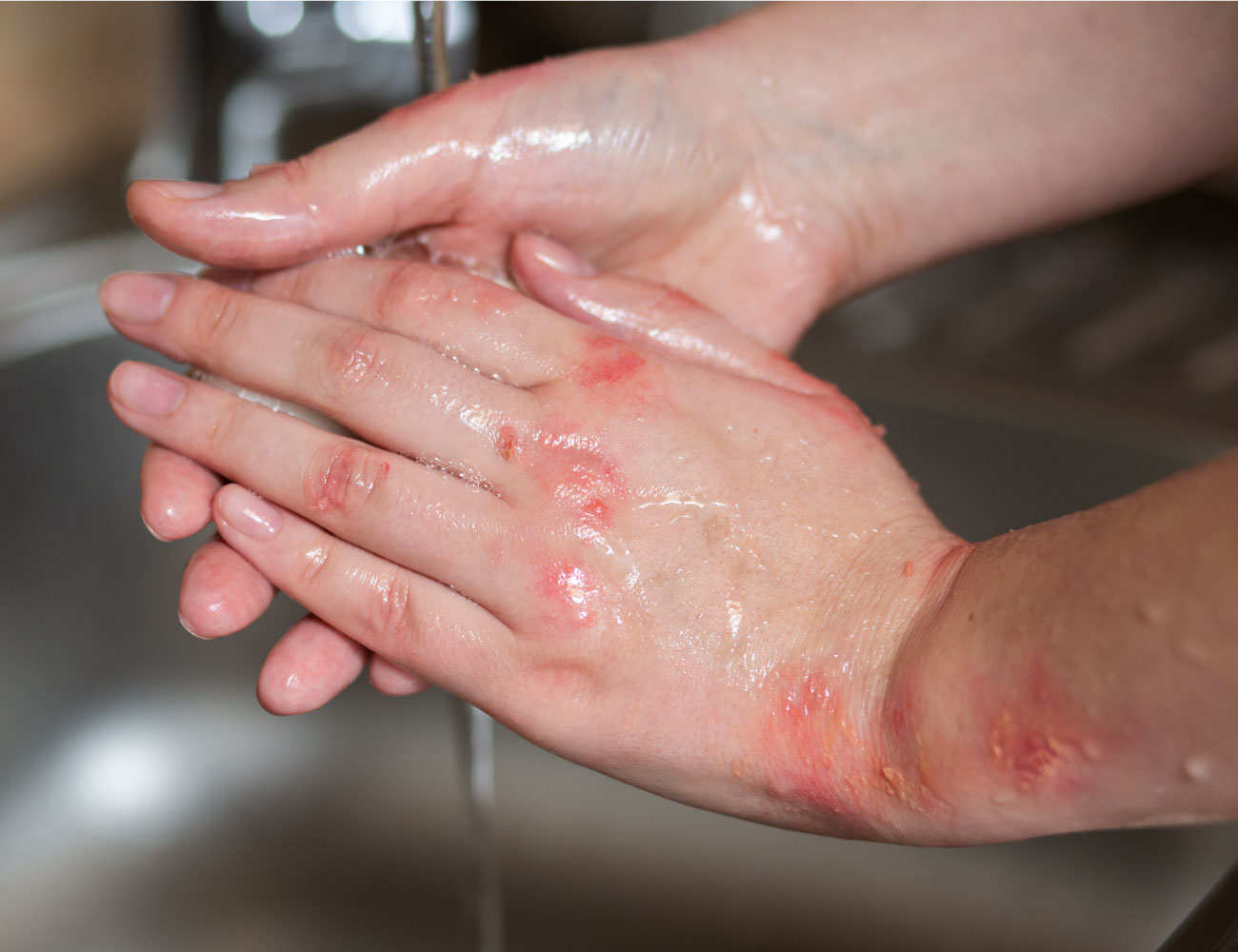 wn-tree-of-life-empire-eczema-testimonial